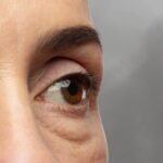 TRATAMIENTO PARA BOLSAS EN LOS OJOS – ENZIMAS RECOMBINANTES
