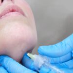 LIPOENZIMÁTICA PAPADA – REDUCCIÓN DE GRASA Y DEFINICIÓN DEL CONTORNO