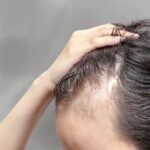 PROTOCOLO CON CÉLULAS MADRE PARA ALOPECIA – REGENERACIÓN CAPILAR AVANZADA