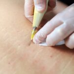 Carboxiterapia - Revitaliza tu piel