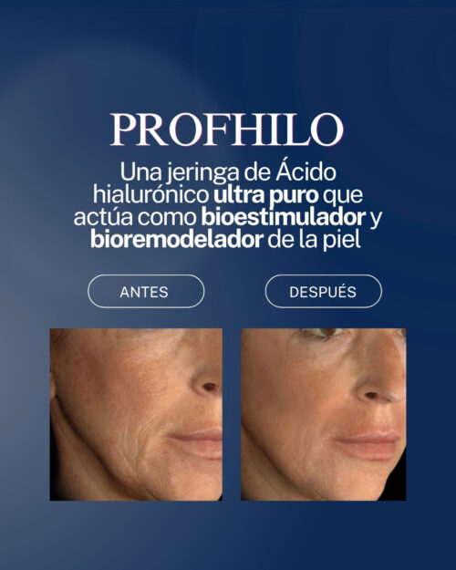 CYBER Profhilo – Bioremodelador y Bioestimulador de Ácido Hialurónico Ultra Puro (1 Jeringa)